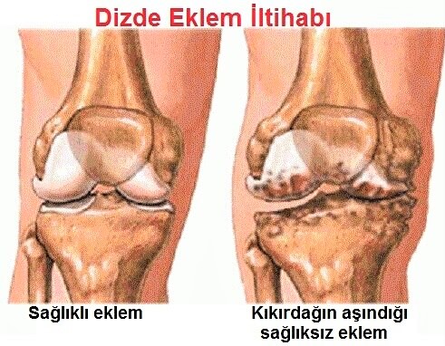eklem ihtihabı